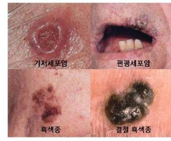 다양한 피부암 병변 실제 모습. /사진제공=서울아산병원