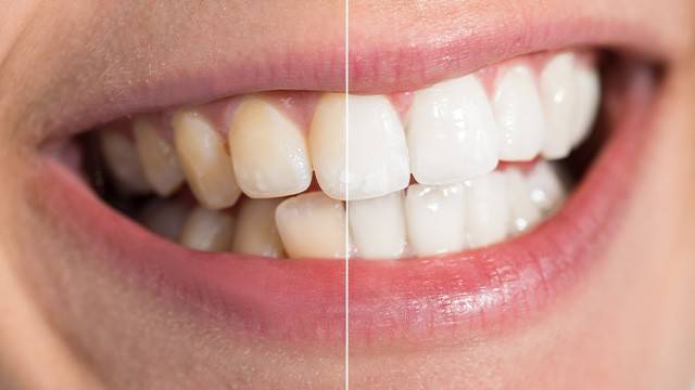 치아가 변색됐다면 이를 유발하는 생활습관이 있는지 되돌아 봐야 한다｜출처: 클립아트코리아