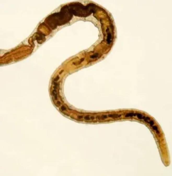 해외 여행을 다녀온 후 기생충에 감염된 30세 여성의 사례가 보고됐다. [사진= 보도 갈무리]