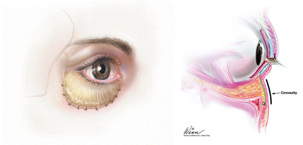 격막강화술의 원리는 약화된 지방의 지지 구조를 함께 강화시키는 것이다. [사진=Aesthetic Surg J 2005;25:628]