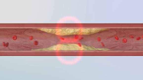 실험 결과, 아스파탐을 섭취한 그룹은 그렇지 않은 그룹보다 혈중 인슐린 수치가 크게 증가했으며, 동맥경화 플라크가 더 빠르게 생성된 것이 확인됐다. 사진은 본 기사 내용과 무관함. [사진=EBS]