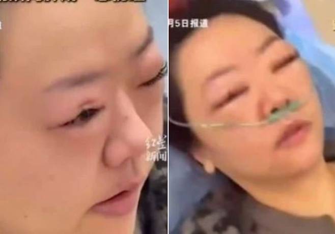 체리를 먹은 뒤 붓고 충혈된 중국 여성의 눈/사진=바스티유포스트