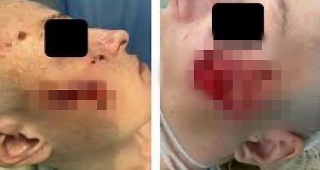 모겔론스병 환자의 피부 사진./사진=WebMD