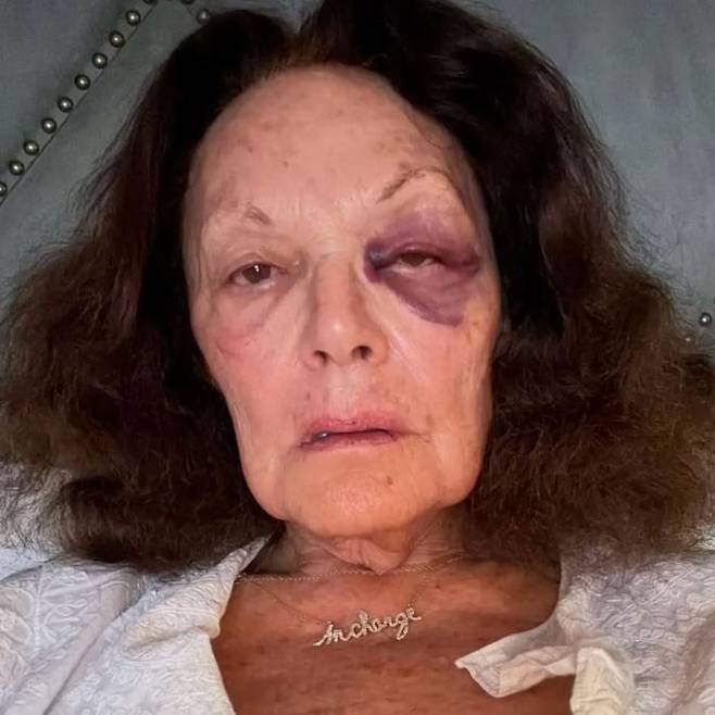 미국의 유명 패션 디자이너인 다이앤 폰 퍼스텐버그가 왼쪽 눈에 파랗게 큰 피멍이 든 사진을 공개했다./사진=뉴욕포스트