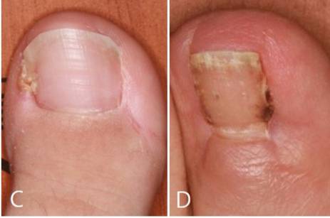 연부조직 절제술을 받은 발톱(C)과 발톱 절제술을 받은 발톱(D). 연부조직 절제술을 받은 발톱이 발톱 절제술을 받은 사례보다 회복 후 발톱 폭이 크게 개선됐다. /사진=세브란스병원