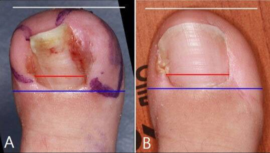 연부조직 절제 후 발톱 폭의 비율을 이미지 분석 방식을 통해 분석한 결과,&nbsp;수술 전(A) 발톱 폭이 좁았던 상태에서 수술 후(B) 발톱 폭의 비율이 최대&nbsp;52.52%까지 개선됐다.