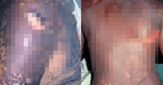 모다피닐과 아르모다피닐을 먹고 온몸에 발진과 물집이 생긴 싱가포르 9명 환자의 피부 상태 (사진=데일리메일)
