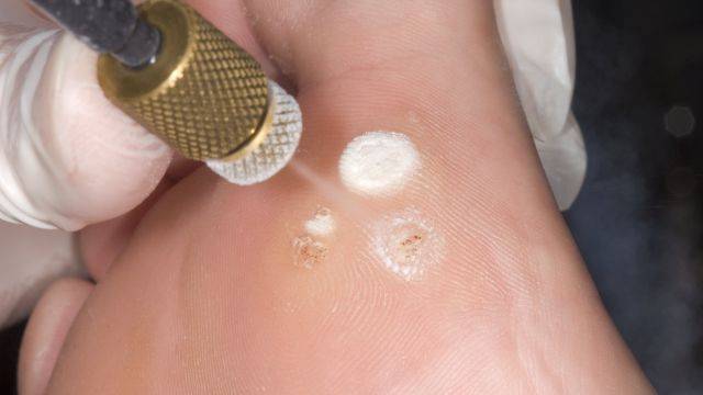 큰 일교차로 인한 면역력 저하는 족저 사마귀를 유발할 수 있다 | 출처: 클립아트코리아