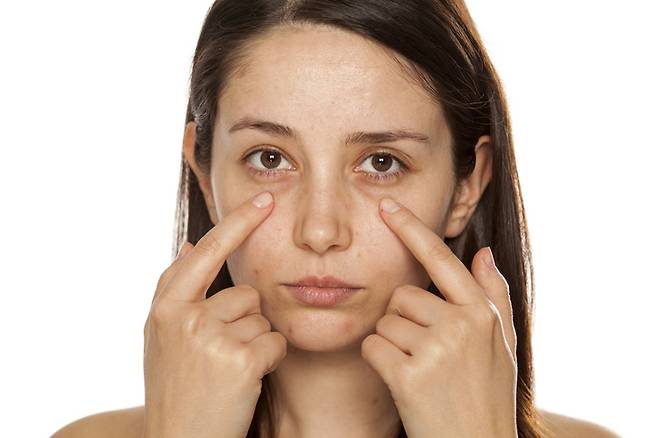 '다크서클'은 눈밑이 어둡게 보이는 증상의 통칭이다. [사진= 게티이미지뱅크]