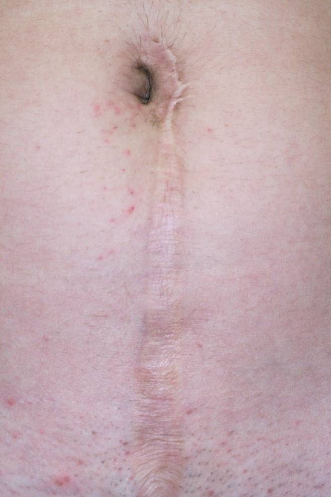 레이저 흉터 치료 기술 ㅎㄷㄷㄷㄷㄷㄷㄷㄷㄷㄷ .jpg