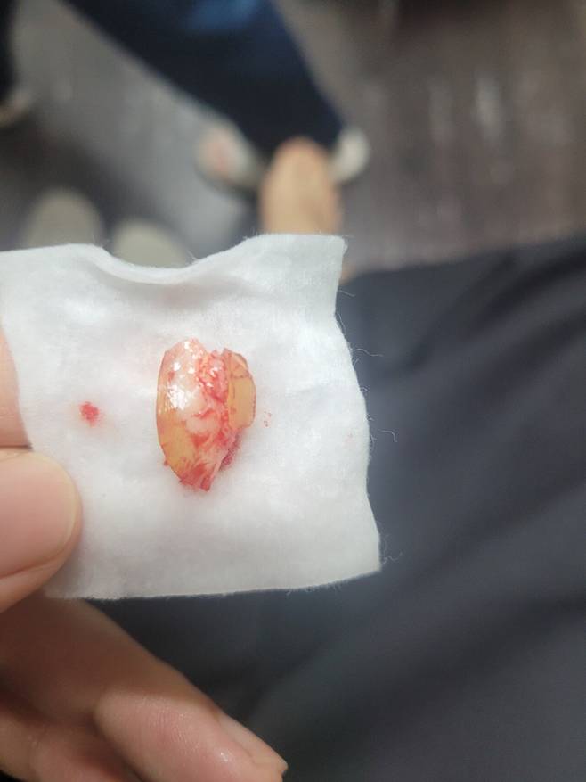 7년된 티눈제거 후기