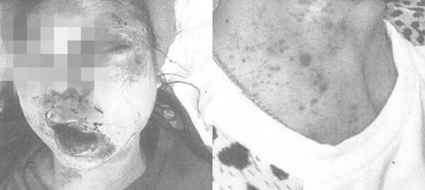 김은지가 전북 익산에 있는 ㅇ병원 응급실을 찾았을 때 모습. 김은지는 ㄱ이 외출하기 어렵도록 얼굴을 집중적으로 때렸다고 기억한다. 목을 조르고 복부 등 몸 곳곳을 발로 차기도 했다. 왼쪽부터 2021년 11월11일, 2022년 9월22일 ㅇ병원 의무기록 일부. 김은지 가족 제공