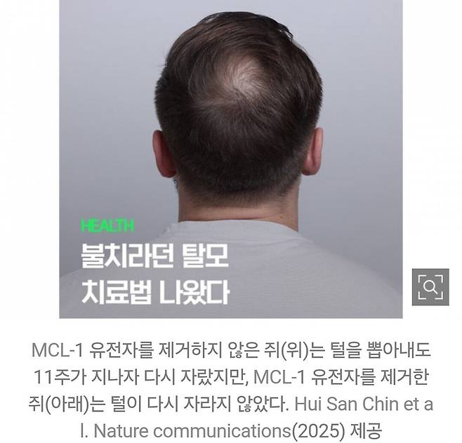 Screenshot_20250405_135127_Gallery.jpg 불치라던 탈모 치료법 나왔다