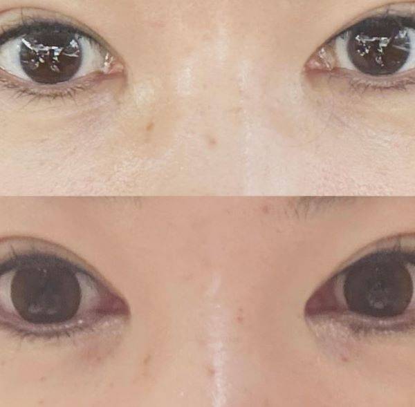 장영란이 서클렌즈를 착용한 사진(왼)과 착용하지 않은 사진(오)을 공개했다./사진=장영란 SNS 캡처