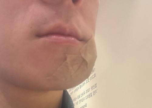 골프공에 맞아 부상을 입은 마라톤대회 참가자. 연합뉴스