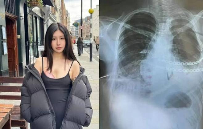 선천성 희귀질환으로 한쪽 가슴이 발달되지 않아 놀림 받던 한 중국 여성이 보석으로 만든 인공 가슴으로 자신감을 되찾은 사연이 소개됐다. [사진= 보도 갈무리]