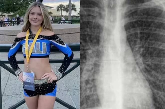 미국에서 학교 치어리더로 활동하던 브리앤 컬런(17)은 3년 동안 매일 전자담배를 피우다가 ‘팝콘 폐’ 진단을 받았다. 오른쪽은 ‘팝콘 폐’ 환자의 폐 자료사진. [사진 출처 = 데일리메일]