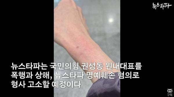 ▲ 권성동 국민의힘 원내대표에게 폭력을 당한 뉴스타파 기자 팔목 상태. 사진=뉴스타파 영상 갈무리