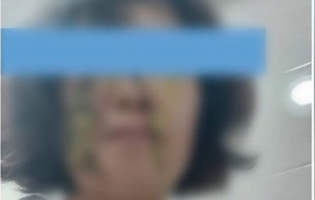 학부모에 똥기저귀를 맞은 어린이집 교사. [사진출처 = SBS 모닝와이드 보도 영상 캡처]