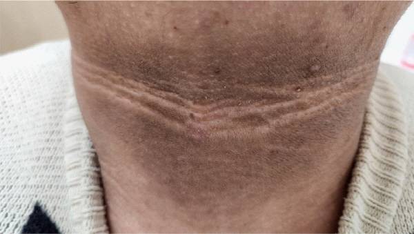 혈당 수치가 높아 인슐린이 과도하게 분비되면 목, 겨드랑이 등이 피부가 거칠어지며 흑색가시세포증이 발생할 수 있다./사진=한국당뇨병저널