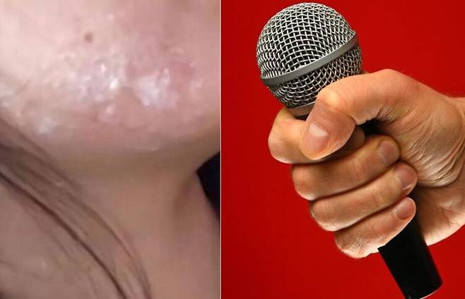 노래방 마이크에 입을 대고 노래를 부른 한 여성이 헤르페스 바이러스에 감염된 사연이 공개됐다. [사진=SNS(왼쪽) / 클립아트코리아]