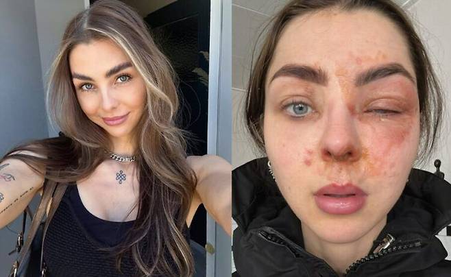 셀러리 주스를 만들던 중 믹서기 속 내용물이 분출되며 얼굴에 1도 화상과 심각한 눈 부상을 입은 한 인플루언서의 사연이 소개됐다. 사진=SNS