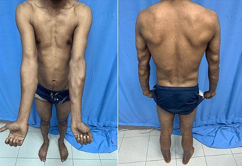 팔과 허리에 지방종이 생긴 더컴병 환자/사진=Cureus