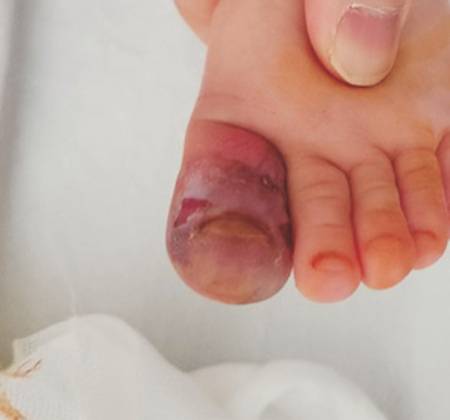 헤르페스 감염이 발생한 22개월 남아의 엄지 발가락 모습./사진=대한족부족관절학회지
