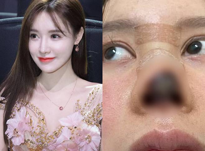 중국의 가수 겸 배우 가오류(29·高溜)가 2020년 코 성형수술을 받은 후 부작용으로 피부가 괴사하는 고통을 겪고 있다는 사실이 재조명 됐다./사진=가오류 인스타그램, 웨이보