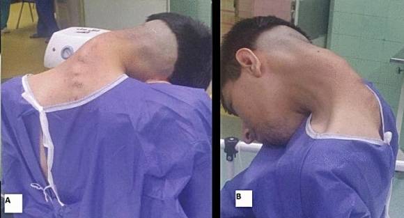 약물 중독으로 머리떨굼증후군(Dropped Head Syndrome, DHS)과 경추후만증(Cervical Kyphoscoliosis, CKS)을 얻은 20대 남성. 이란 이스파한의과대학 신경외과 자료