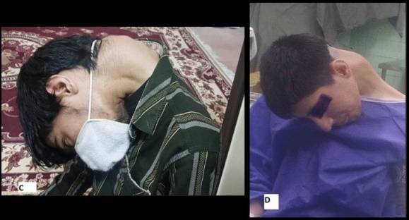 약물 중독으로 머리떨굼증후군(Dropped Head Syndrome, DHS)과 경추후만증(Cervical Kyphoscoliosis, CKS)을 얻은 20대 남성. 이란 이스파한의과대학 신경외과 자료