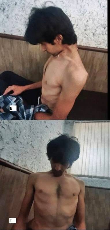 약물 중독으로 머리떨굼증후군(Dropped Head Syndrome, DHS)과 경추후만증(Cervical Kyphoscoliosis, CKS)을 얻은 20대 남성. 이란 이스파한의과대학 신경외과 자료