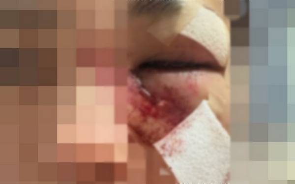 경북 포항에서 연인에게 폭행당한 20대 여성[뉴시스. 독자 제공]