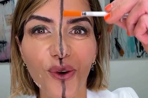 미용의학 전문의인 비타 파렐 박사는 얼굴 정중앙을 따라 선을 그어 구분한 뒤, 오른쪽 부분에만 보톡스를 주입하는 과정을 상세히 담은 영상을 온라인에 공개했다. 인스타그램 캡처