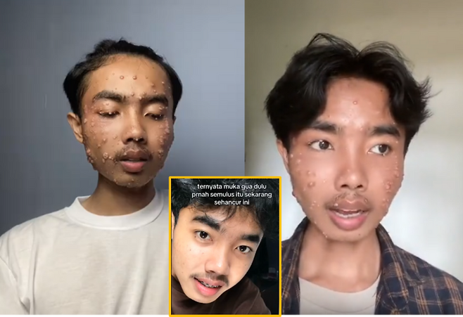 세탁하지 않은 중고 의류를 착용한 후 피부병에 걸린 한 남성의 사연이 온라인상에서 화제다. [사진=SNS 틱톡 @onenevertwhoo_one]