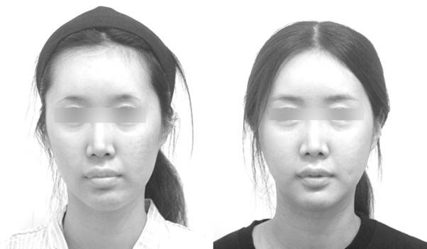 실제 수술의 결과를 보면 입술의 대칭까지 함께 개선되었습니다.