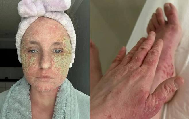 스테로이드 연고의 부작용을 겪고 있는 여성이 자신의 충격적인 모습을 공유했다. [사진=SNS]