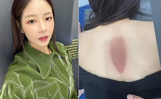 배우 박하나가 신혼여행 후 화상을 입었다. [사진=박하나 인스타그램]