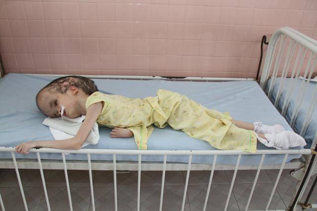 2011년 베트남 호찌민시 인근의 한 병원 고엽제 피해자 수용 시설에 한 어린이가 입원해 있다. 김성찬씨 제공