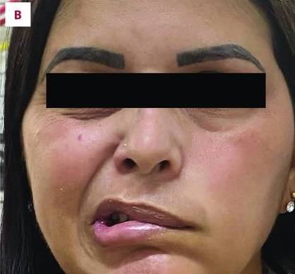 안면 근육 마비가 나타난 멜커슨 로젠탈 증후군 환자/사진=American Journal of Case Reports