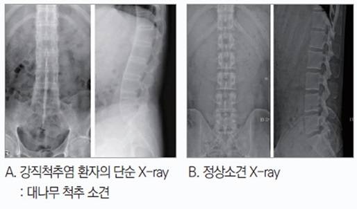 강직성척추염 환자의 단순 X-ray와 정상 X-ray