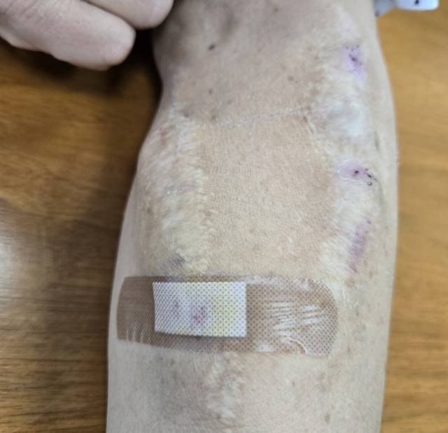 지난 3월 27일 부산 장애인종합회관에서 만난 신장 이식 대기자 오성옥(58) 씨의 왼팔에는 전날 꽂힌 투석 주삿바늘의 흔적이 남아 있었다. 성옥 씨의 팔은 이틀에 한 번 투석 주사를 맞으며 흉터로 가득했다. 오른팔 또한 같은 모습이었다. 임재환 기자