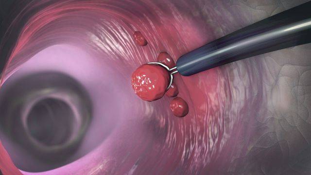 증상이 없어도 주기적인 내시경 검사를 통해 병변을 확인해야 한다| 출처: 클립아트코리아