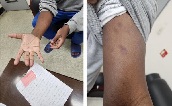 지난달 18일 화성외국인보호소에서 강제송환을 시도하는 과정에서 부상을 입었다는 V씨가 자신의 팔과 손바닥을 펼쳐 보이고 있다. 팔목에는 수갑 자국으로 보이는 희미한 상처와 멍 자국이 남아 있다. /화성외국인보호소방문시민모임 ‘마중’ 제공