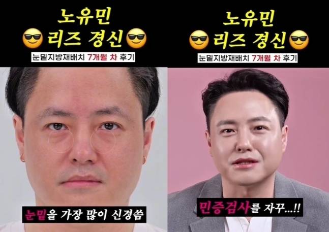 노유민이 모발이식에 이어 눈 밑 지방재배치 시술로 전성기 비주얼을 되찾았다. 노유민 인스타그램 갈무리