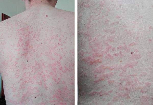 두드러기가 발생한 슈니츨러 증후군 환자 사진/사진=International Journal of General Medicine