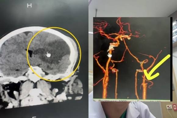 경동맥이 끊어져 뇌 일부가 손상된 환자의 뇌 스캔(왼쪽) 결과. [SNS 갈무리]