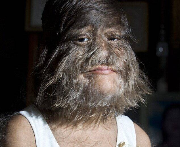 수파트라는 2010년 '세계에서 가장 털이 많은 10대'로 기네스북 세계 기록도 세웠다. 기네스북 등재 당시 수파트라는 "털은 나를 특별하게 만든다"며 "내 인생에서 가장 행복한 날"이라고 했다. [사진=SNS]