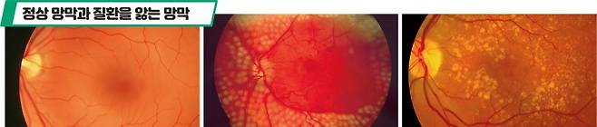 정상망막과 질환을 앓는 망막(왼쪽부터 정상 망막의 모습, 당뇨망막병증 환자의 눈. 망막의 혈관이 손상돼 있다, 황반변성 환자의 눈. 황반변성은 눈 조직 중 황반에 변성이 발생하는 질환이다. 퍼블릭도메인 제공