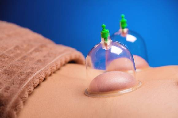 부항 치료 이미지. 아이클릭아트